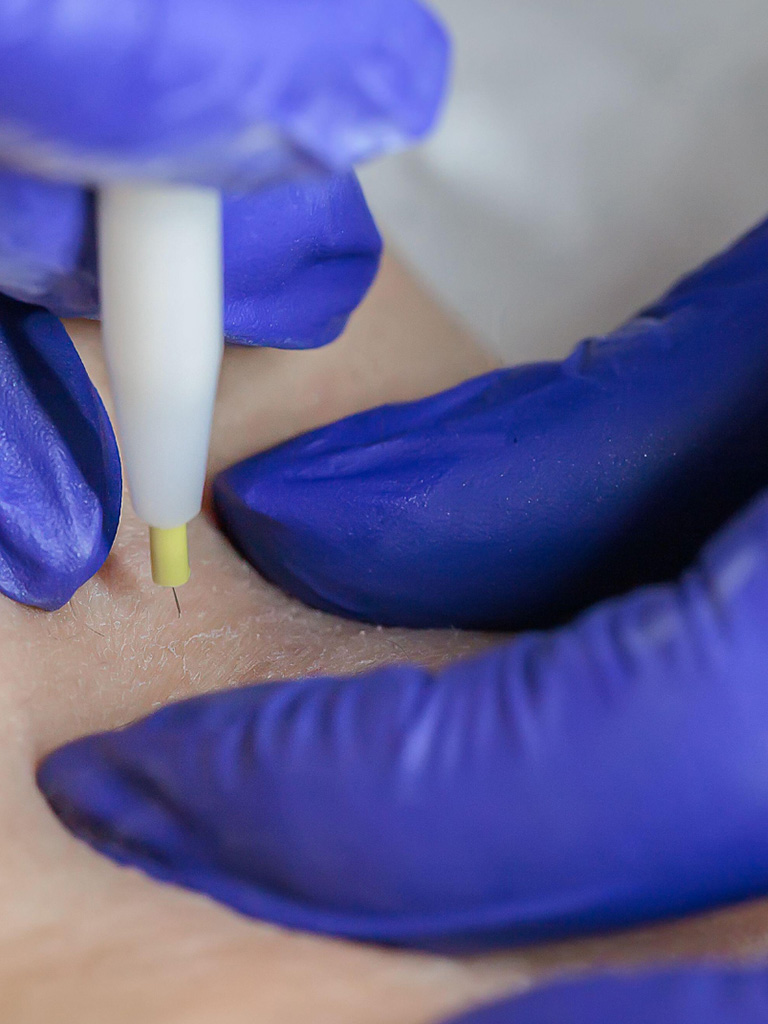 gabys-electrolysis-services-treatments-Permanent-Abdominal-Hair-Removal-with-Electrolysis-