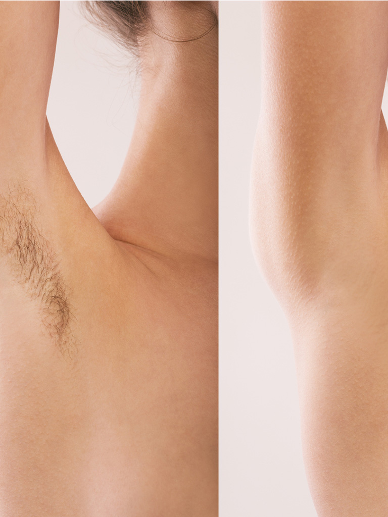 gabys-electrolysis-services-treatments-Permanent-Underarm-Hair-Removal-with-Electrolysis